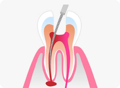 통증의 원인이 되는 감염된 신경 조직을 세밀하게 제거하여 염증 확산을 방지하고 자연치아를 살리는 영도 편한치과 신경치료
